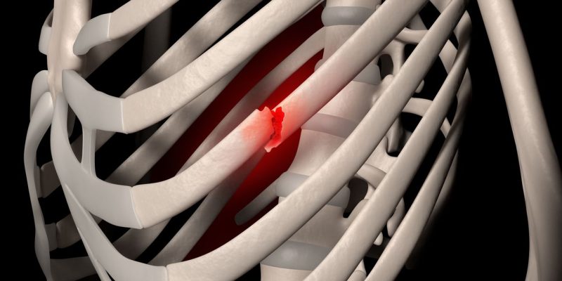 Rib Pain Clinic, Mr N Panagiotopoulos, Consultant Thoracic Surgeon