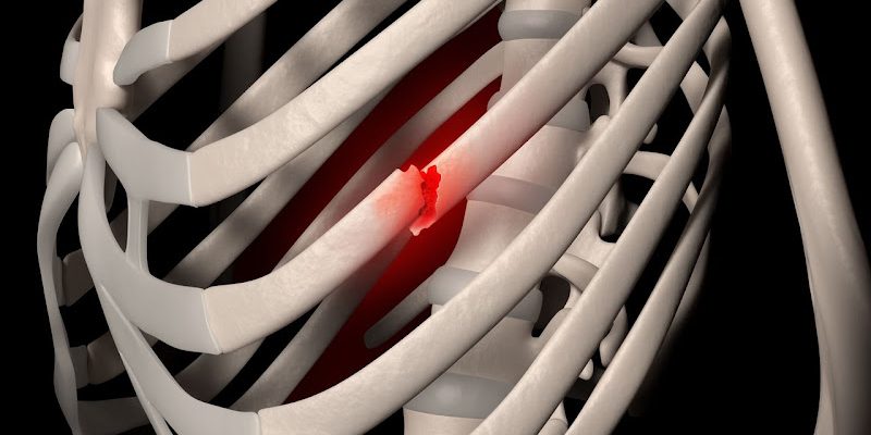 Rib Pain Clinic, Mr N Panagiotopoulos, Consultant Thoracic Surgeon